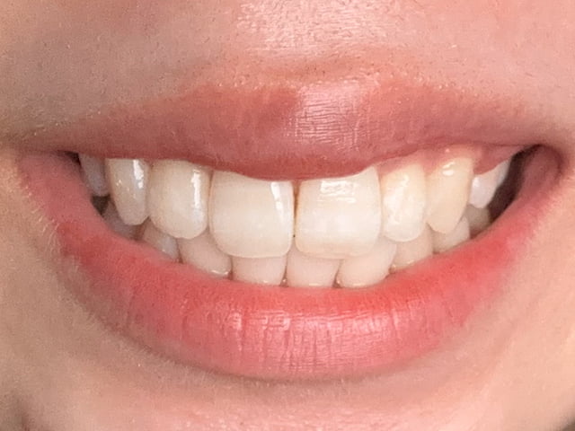 ホワイトニング後の写真