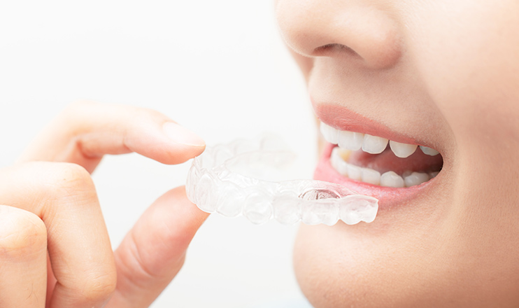 マウスピース矯正