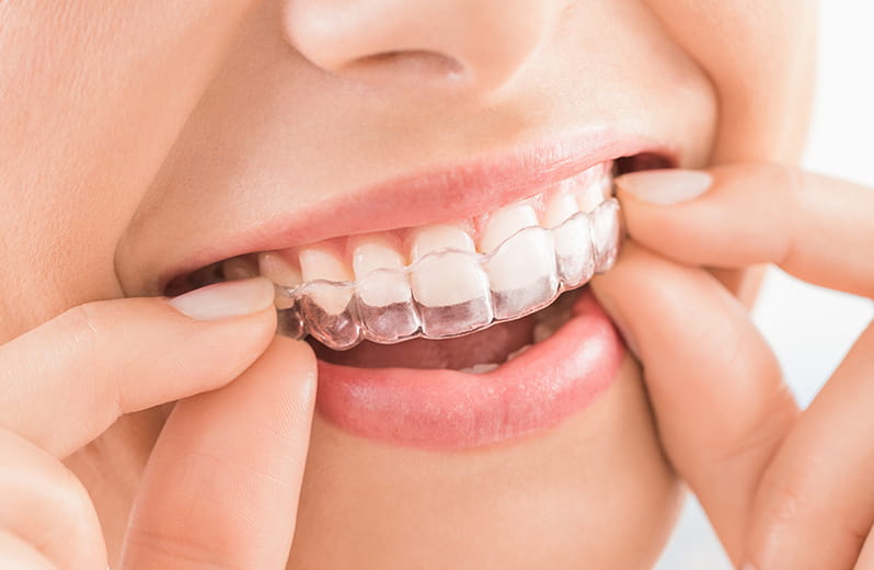 マウスピース矯正