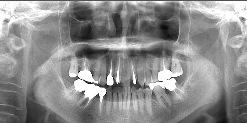 治療後の歯のレントゲン画像