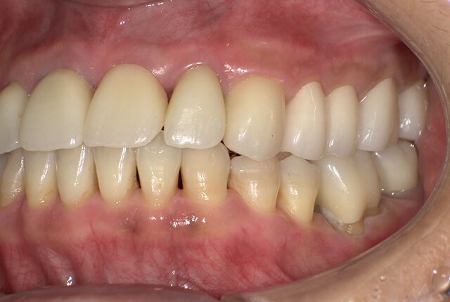 治療後の歯の写真