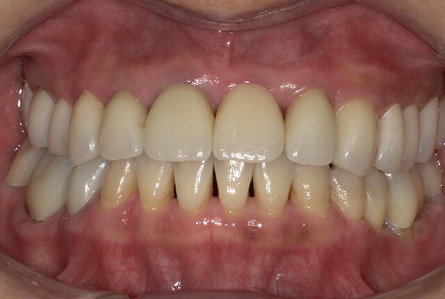治療後の歯の写真
