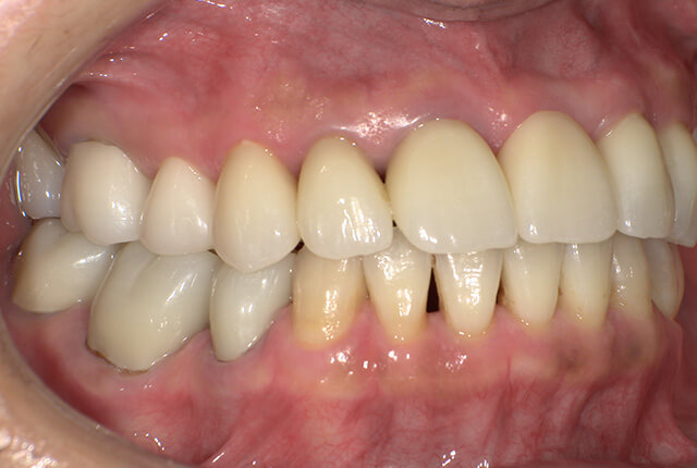 治療後の歯の写真