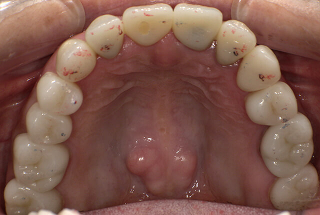 治療後の歯の写真