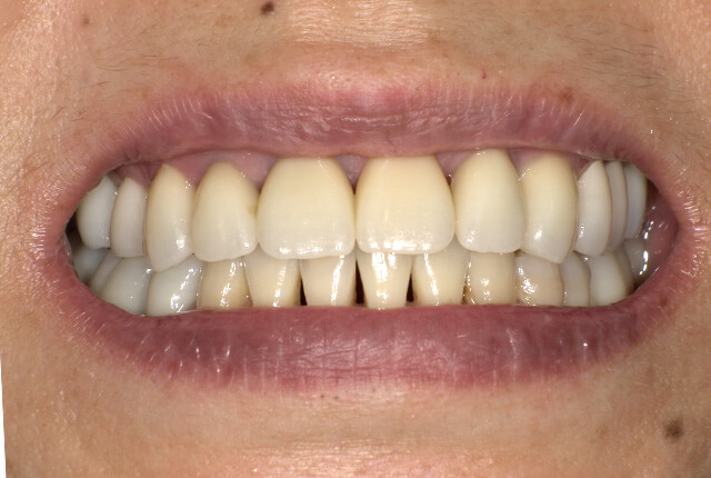 治療後の歯の写真