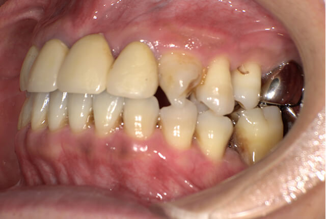 初診時の歯の写真
