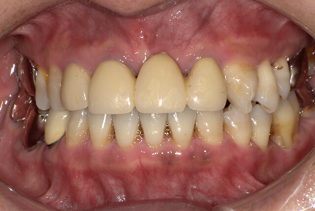 初診時の歯の写真
