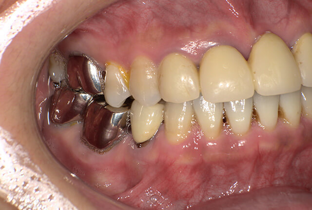 初診時の歯の写真