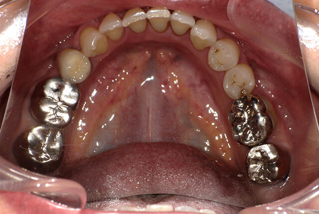 初診時の歯の写真