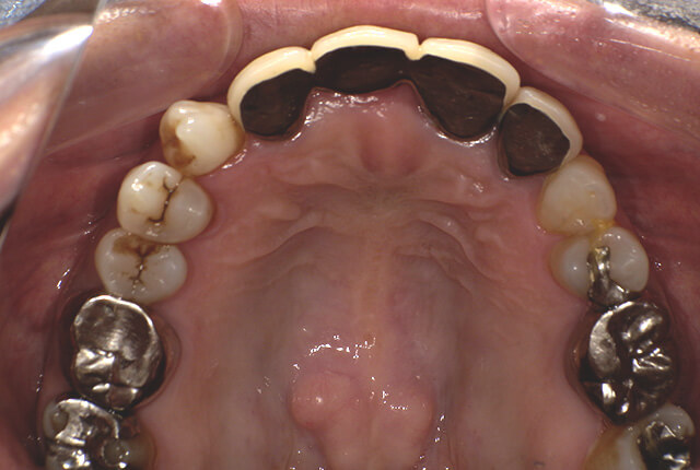 初診時の歯の写真