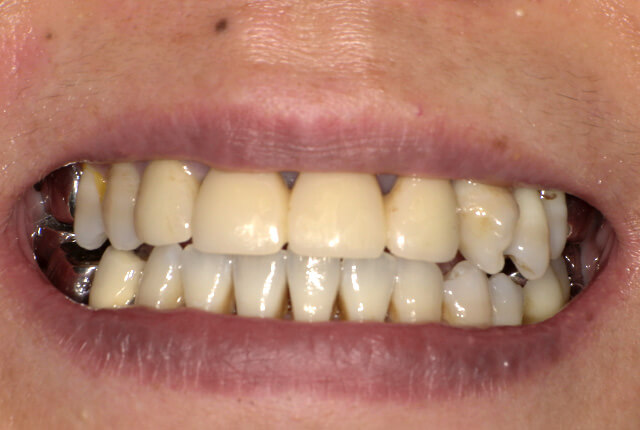 初診時の歯の写真