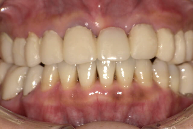 仮歯中の歯の写真
