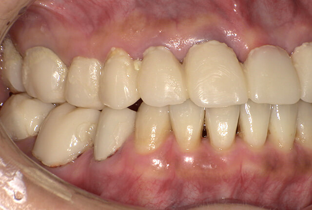 仮歯中の歯の写真