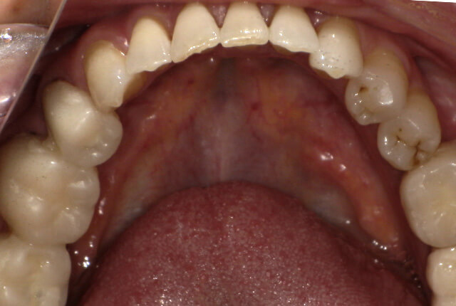 仮歯中の歯の写真