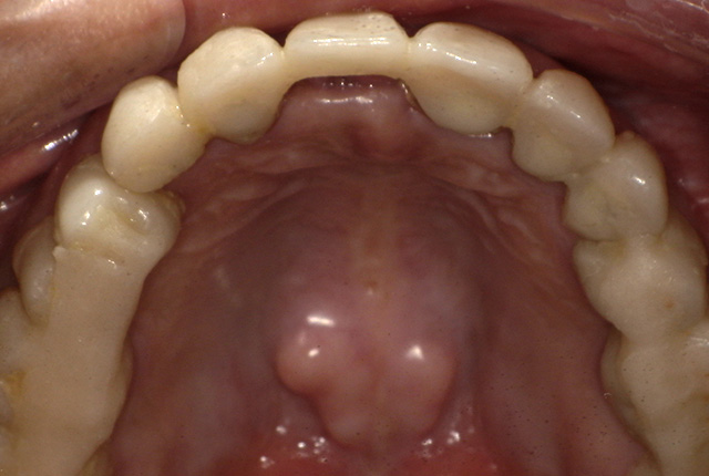 仮歯中の歯の写真