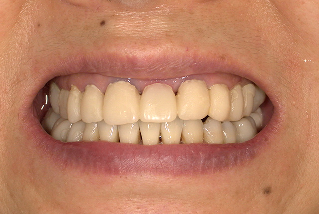 仮歯中の歯の写真