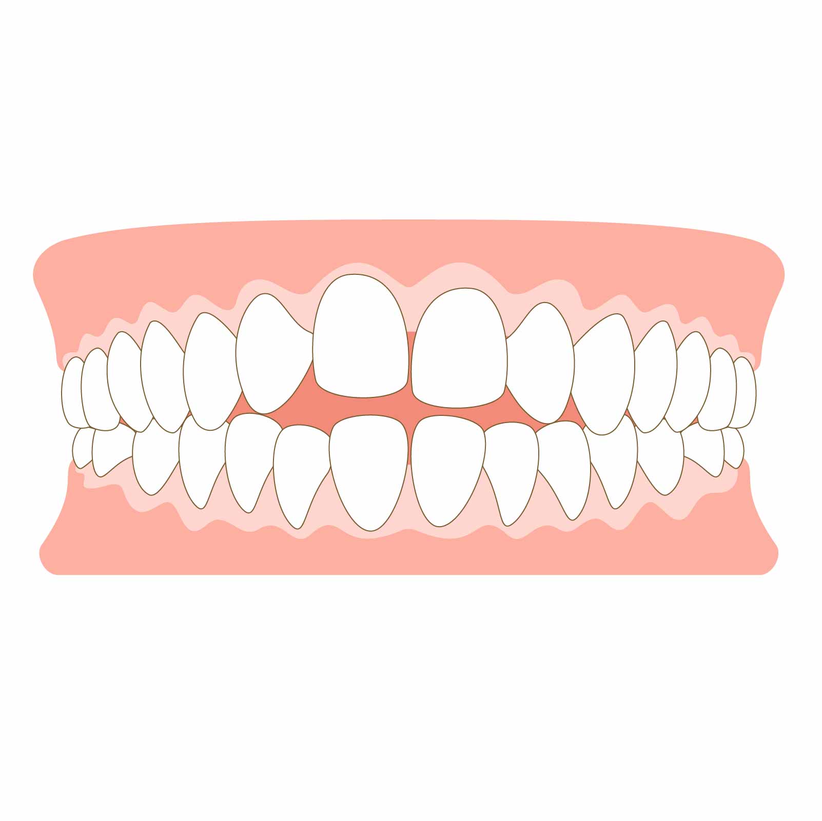 オープンバイトは矯正で治る？開咬の原因と治療のポイント